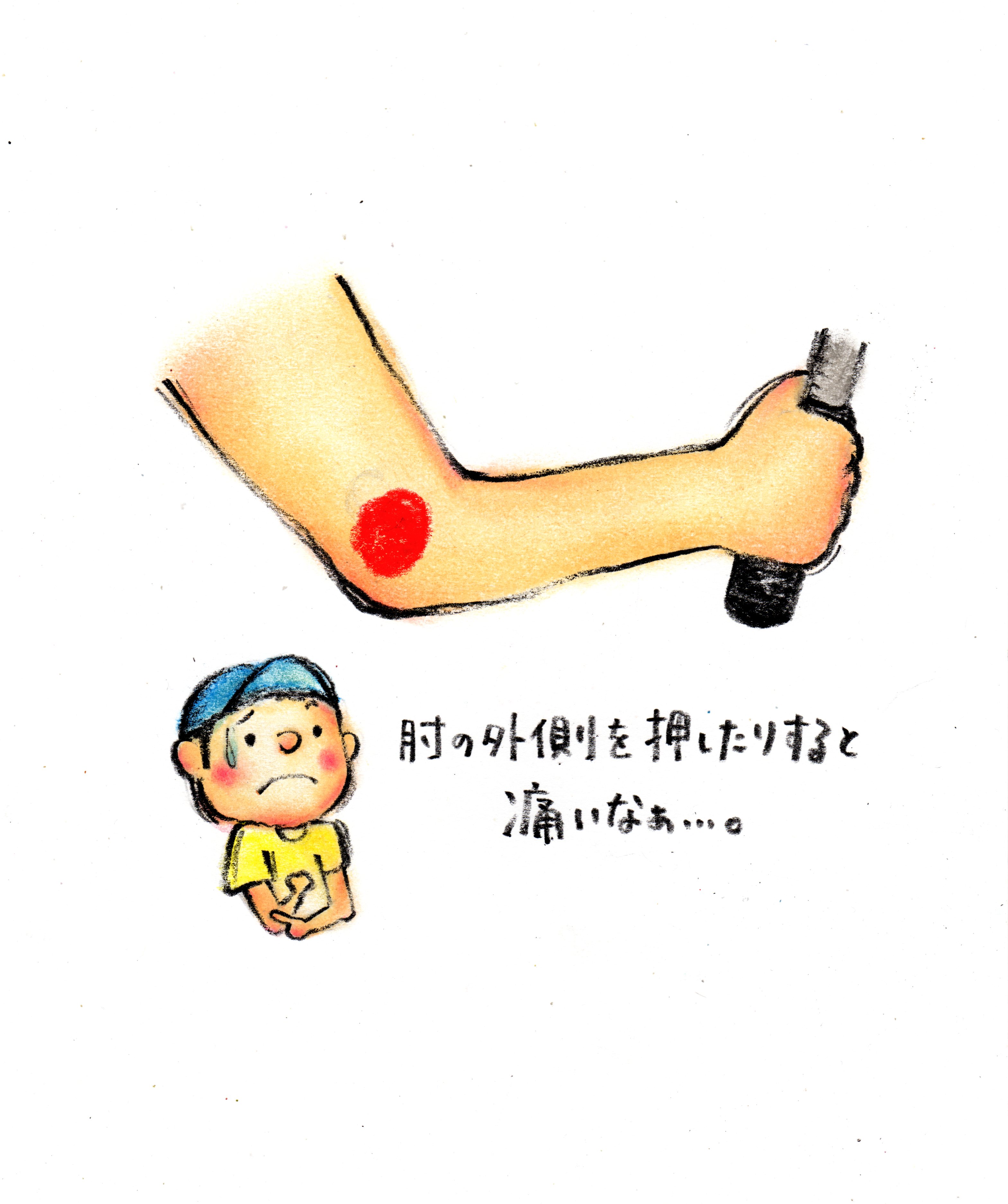 外傷性外側側副靭帯損傷 肘 トレシピ