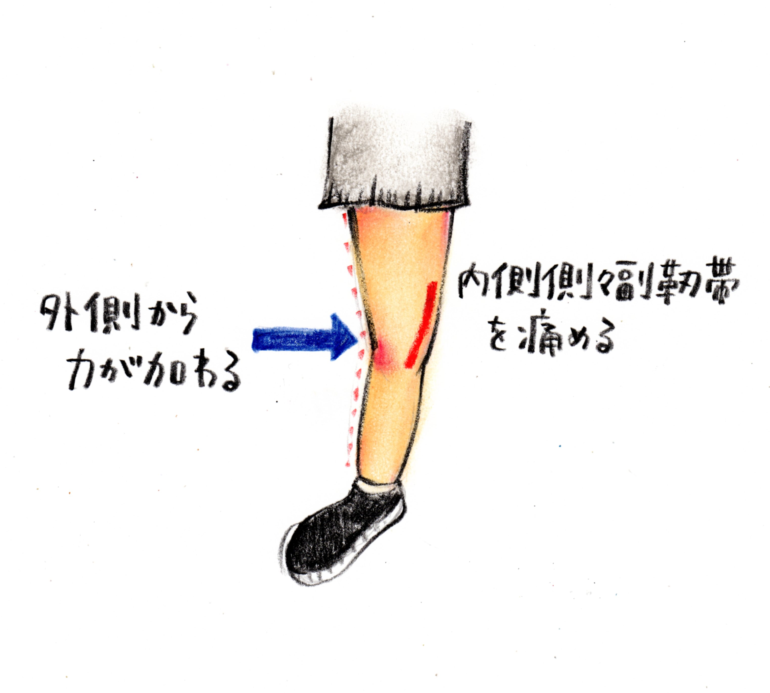 内側側副靭帯損傷 膝 トレシピ