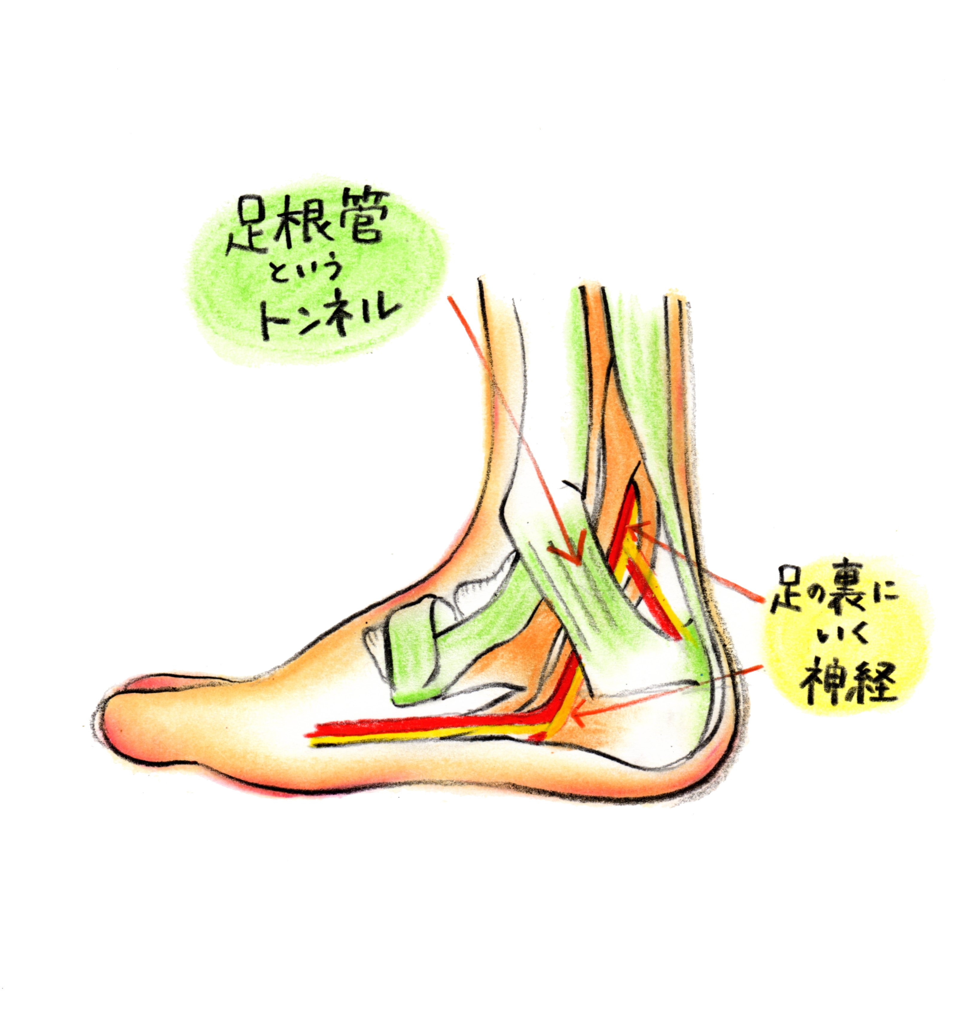 足根管症候群 トレシピ