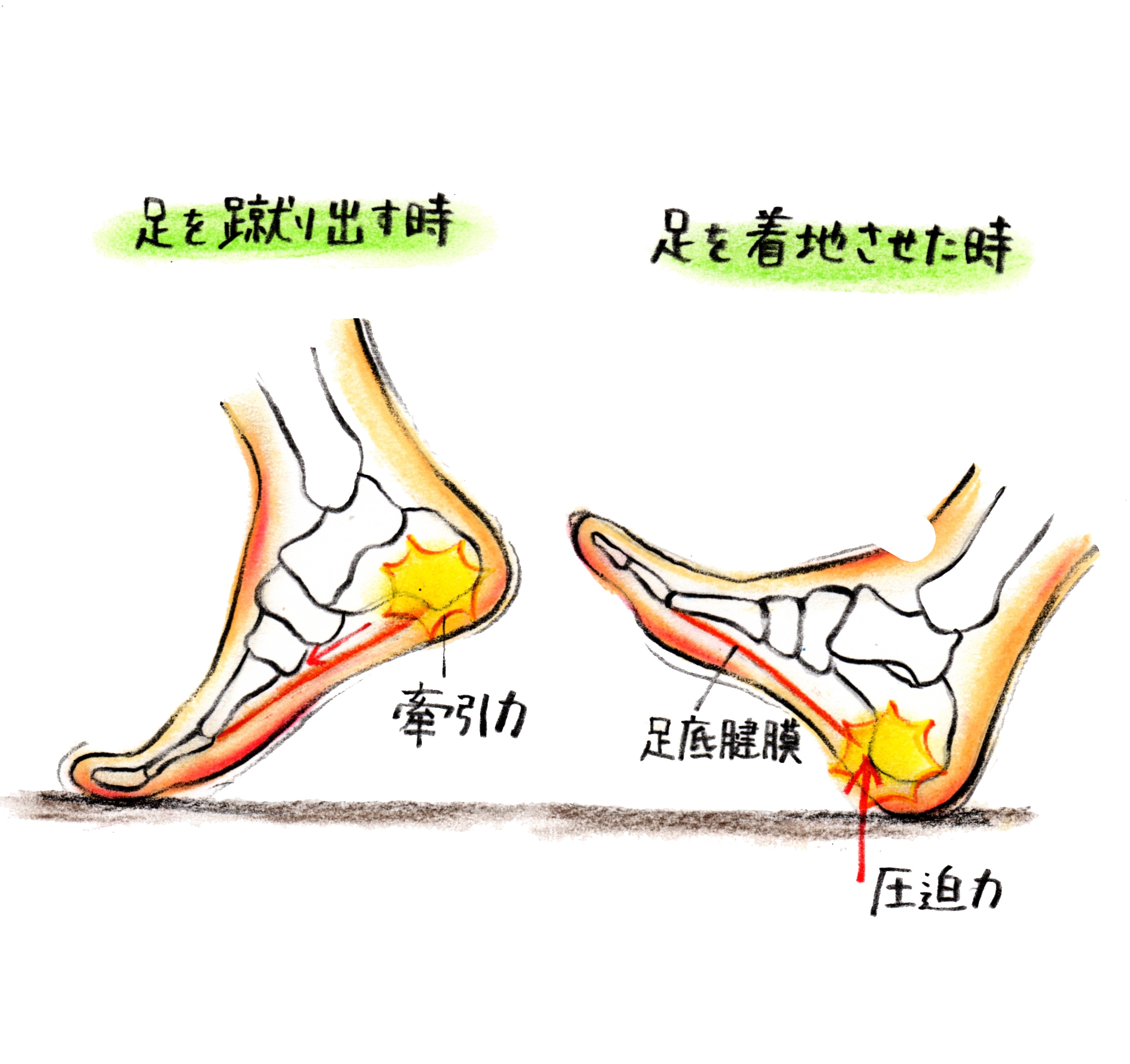 足底筋膜炎 トレシピ